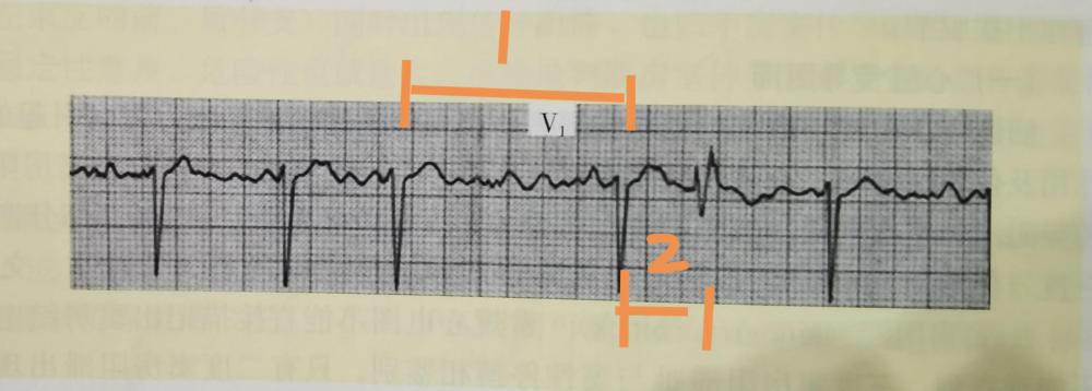 房颤的心电图分析诀窍和房颤的科普解释，专业和通俗的完美结合